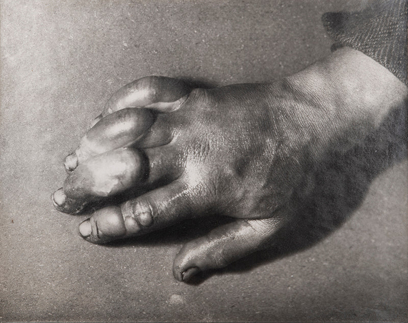 Classic Herbert Ponting photograph from Captain Scott's Terra Nova expedition (1910-1913), showing the effects of frostbite on the hand of a team member
