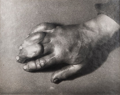 Classic Herbert Ponting photograph from Captain Scott's Terra Nova expedition (1910-1913), showing the effects of frostbite on the hand of a team member