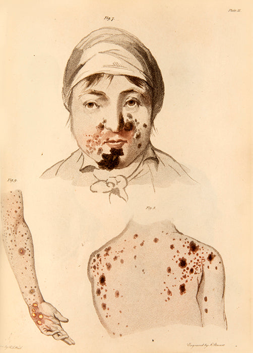 An Essay on the Venereal Diseases which have been Confounded with Syphilis