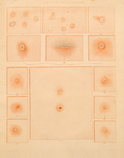 First edition one of the earliest detailed accounts of vaccination, On Vaccine Inoculation by Robert Willan, the founder of dermatology.